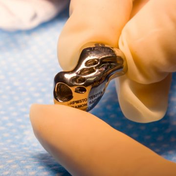 Fita a La Ribera | Imatges del primer implant d’una pròtesi 3D a Espanya